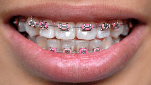 Traditional Braces at Total Orthodontics in Tree and Greenwood Village CO