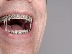 Rubber Bands For Braces Explained Total Orthodontics Greenwood